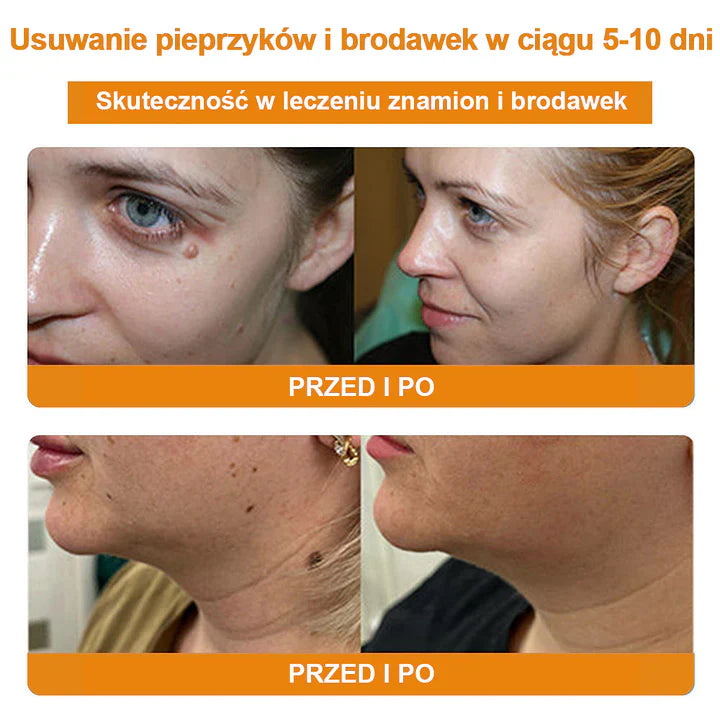 【✨Za pobraniem✨】Vsoxa™ Krem do usuwania brodawek i pieprzyków z jadem pszczelim (👨⚕Zalecenia AAD) 🐝🐝 (🔥Ostatni dzień wyprzedaży 70% taniej)