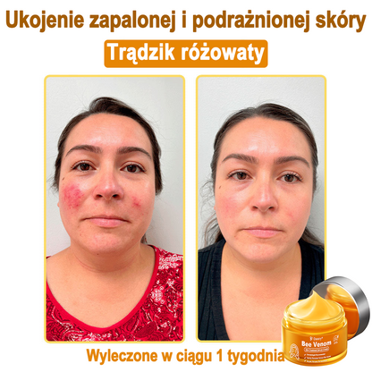 Daasry® 𝑩𝒆𝒆 𝑽𝒆𝒏𝒐𝒎 𝑺𝒌𝒊𝒏 𝑻𝒓𝒆𝒂𝒕𝒎𝒆𝒏𝒕 𝑺𝒆𝒓𝒖𝒎 𝑪𝒓𝒆𝒂𝒎👨‍⚕️ (Suitable for all ages & TGA recommends)