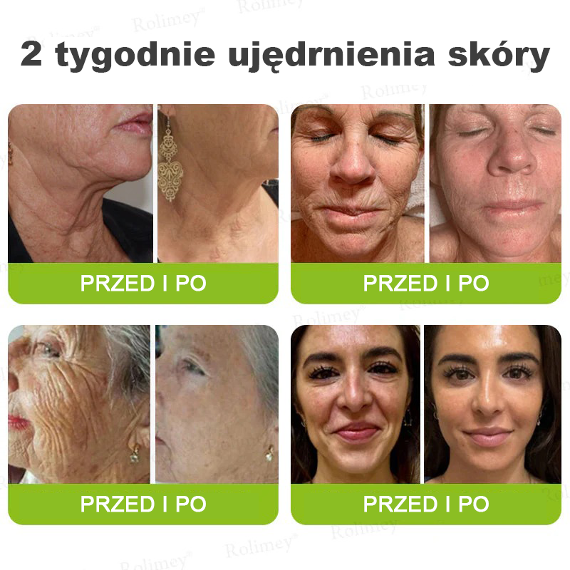 👨‍⚕️🇺🇸Najnowocześniejsze amerykańskie osiągnięcie w walce z oznakami starzenia ✅ Rolimey® krem przeciwzmarszczkowy z botoksem i retinolem Vita-A – Ostatni dzień promocji, 70% TANIEJ⏰