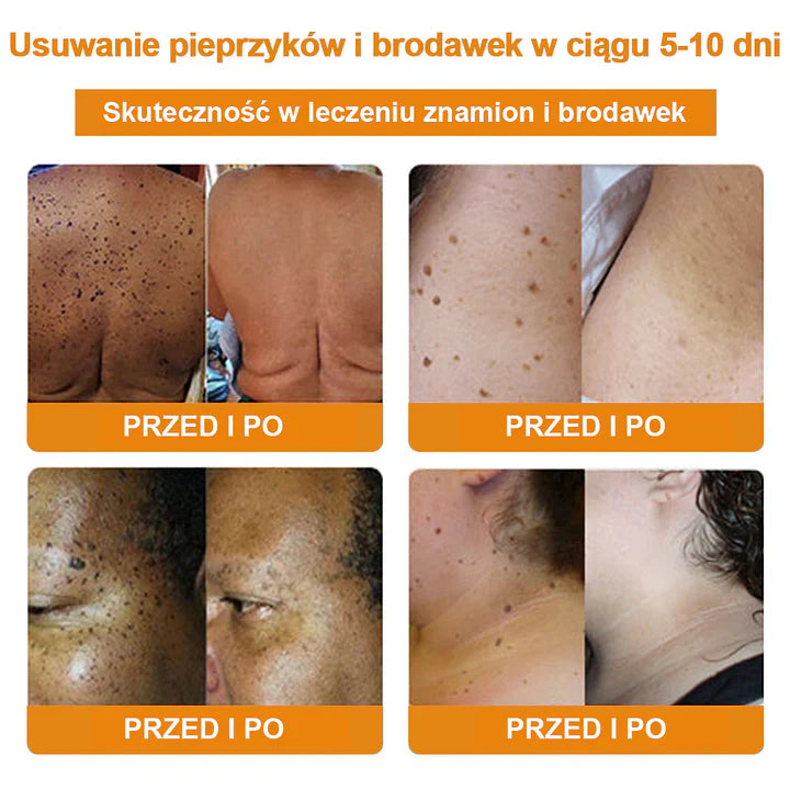 【✨Za pobraniem✨】Vsoxa™ Krem do usuwania brodawek i pieprzyków z jadem pszczelim (👨‍⚕Zalecenia AAD) 🐝🐝 (🔥Ostatni dzień wyprzedaży 70% taniej)