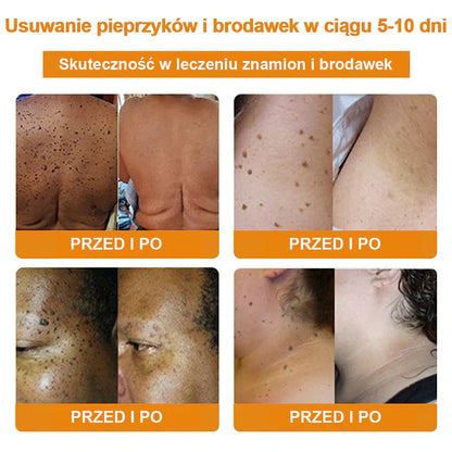 【✨Za pobraniem✨】Vsoxa™ Krem do usuwania brodawek i pieprzyków z jadem pszczelim (👨‍⚕Zalecenia AAD) 🐝🐝 (🔥Ostatni dzień wyprzedaży 70% taniej)
