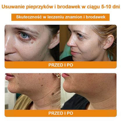 【✨Za pobraniem✨】Vsoxa™ Krem do usuwania brodawek i pieprzyków z jadem pszczelim (👨‍⚕Zalecenia AAD) 🐝🐝 (🔥Ostatni dzień wyprzedaży 70% taniej)