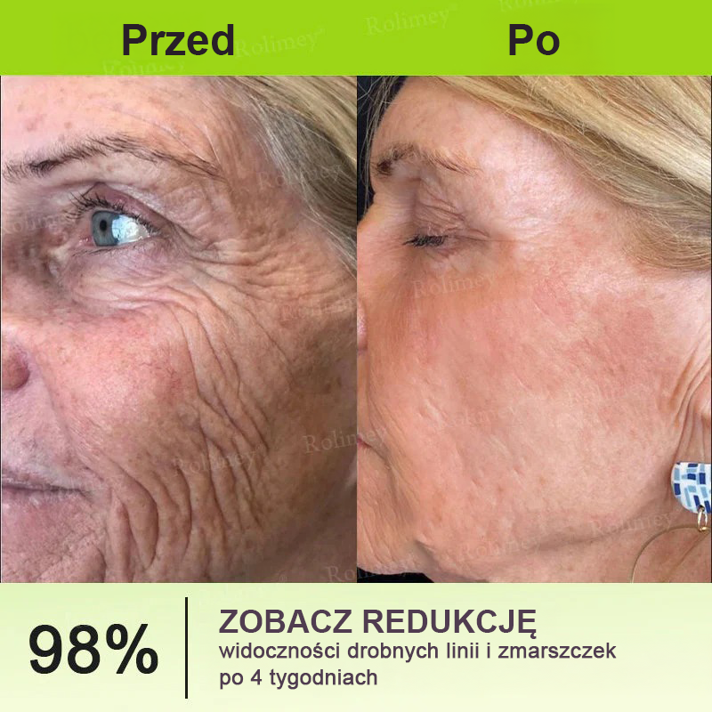 👨‍⚕️🇺🇸Najnowocześniejsze amerykańskie osiągnięcie w walce z oznakami starzenia ✅ Rolimey® krem przeciwzmarszczkowy z botoksem i retinolem Vita-A – Ostatni dzień promocji, 70% TANIEJ⏰