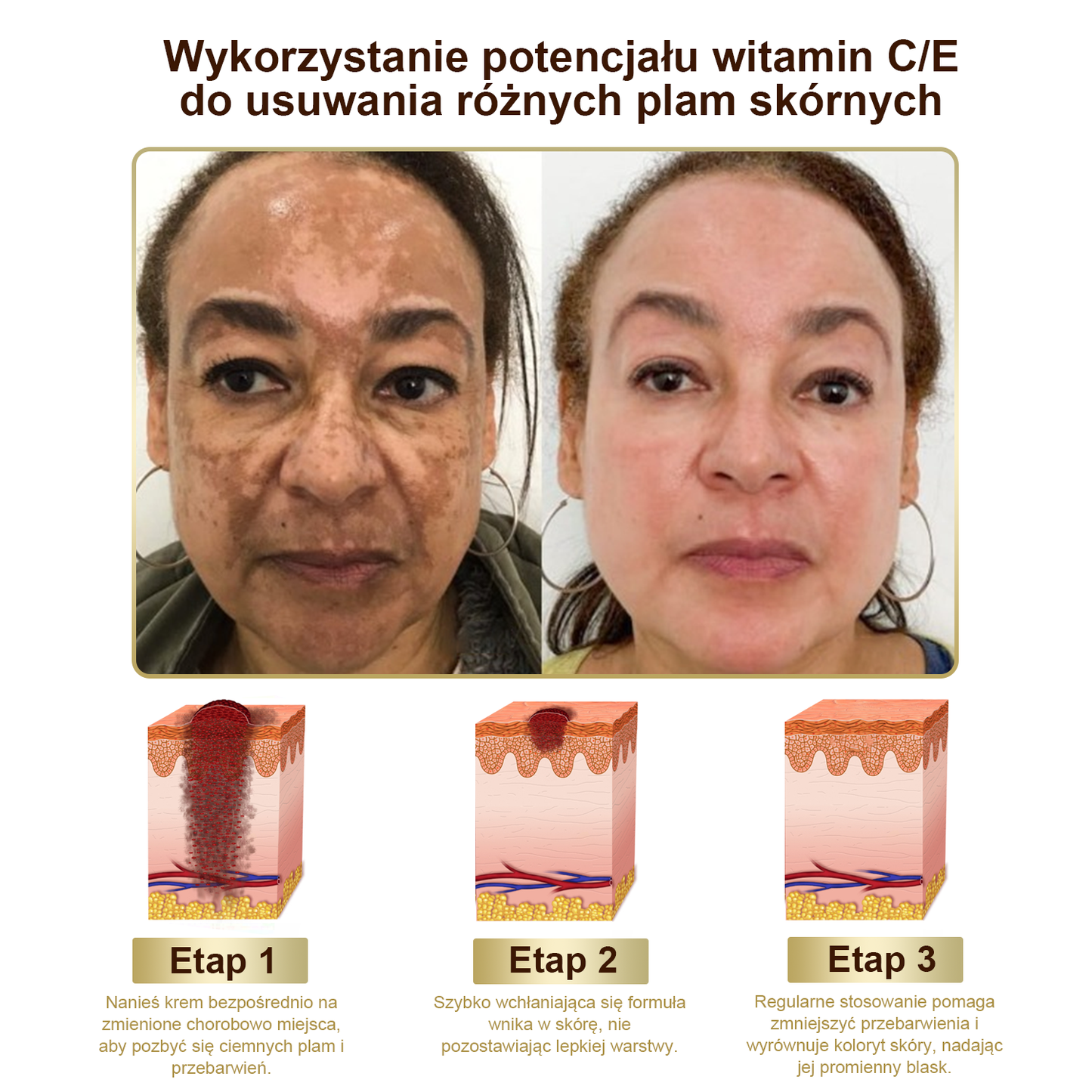 Gotówka przy odbiorze] flysmus™ Bee Venom Wart and Mole Removal Skin Cream (👨‍⚕Zalecenia AAD) 🐝🐝 (🔥Ostatni dzień promocji 70% taniej)