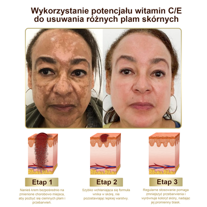 Gotówka przy odbiorze] flysmus™ Bee Venom Wart and Mole Removal Skin Cream (👨‍⚕Zalecenia AAD) 🐝🐝 (🔥Ostatni dzień promocji 70% taniej)