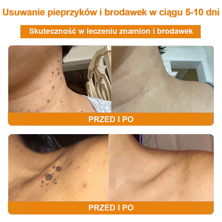 【✨Za pobraniem✨】Vsoxa™ Krem do usuwania brodawek i pieprzyków z jadem pszczelim (👨‍⚕Zalecenia AAD) 🐝🐝 (🔥Ostatni dzień wyprzedaży 70% taniej)