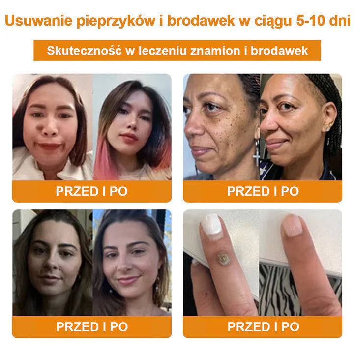 【✨Za pobraniem✨】Vsoxa™ Krem do usuwania brodawek i pieprzyków z jadem pszczelim (👨‍⚕Zalecenia AAD) 🐝🐝 (🔥Ostatni dzień wyprzedaży 70% taniej)