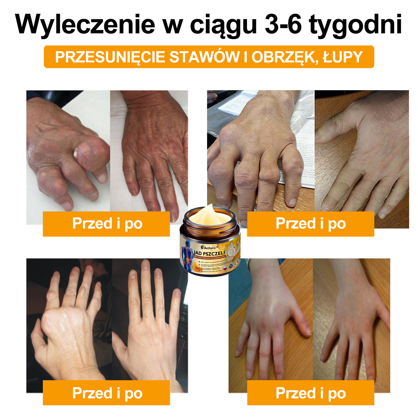 Oficjalny sklep: Aetheris™ Krem terapeutyczny z jadem pszczelim na natychmiastową, ultra silną ulgę w bólu - (Zapewnia eliminację bólu przy zapaleniu stawów, bólach mięśni, pleców, kolan, ramion, bioder, nadgarstków, dłoni)