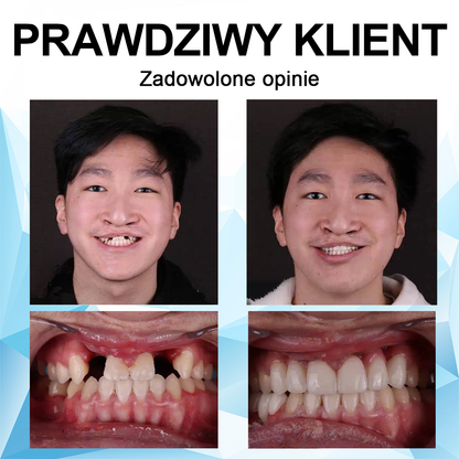 👨‍⚕🦷 Furzero™Regulowana proteza - najlepsza alternatywa dla drogich aparatów ortodontycznych!🥰