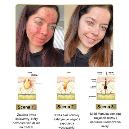 Gotówka przy odbiorze] flysmus™ Bee Venom Wart and Mole Removal Skin Cream (👨‍⚕Zalecenia AAD) 🐝🐝 (🔥Ostatni dzień promocji 70% taniej)