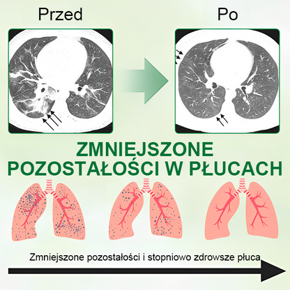 [Oficjalny flagowy sklep marki]👨‍⚕️MIQIKO® Zaawansowany spray oczyszczający płuca (☘️zalecany przez specjalistów od płuc☘️) ☘️☘️☘️