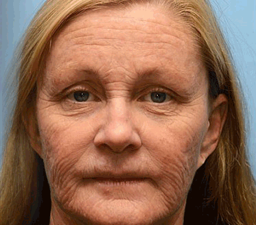 👨‍⚕️🇺🇸Najnowocześniejsze amerykańskie osiągnięcie w walce z oznakami starzenia ✅ Rolimey® krem przeciwzmarszczkowy z botoksem i retinolem Vita-A – Ostatni dzień promocji, 70% TANIEJ⏰